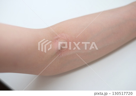 採血をした後の腕 採血をした後の腕 130517720