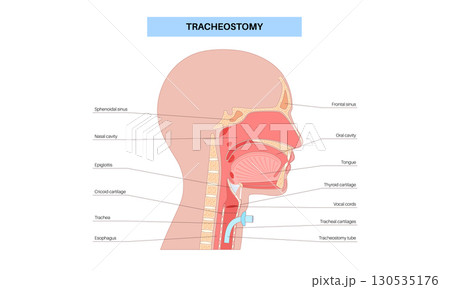 Tracheostomy medical poster Tracheostomy medical poster 130535176