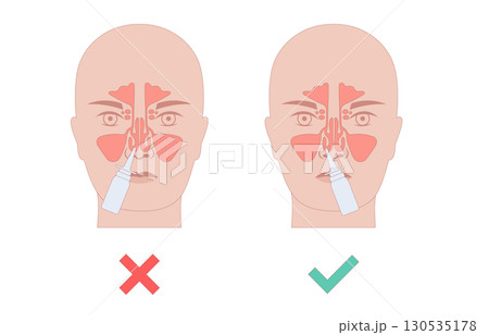 Proper nasal spray usage Proper nasal spray usage 130535178