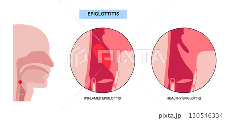 Epiglottitis medical poster 130546334