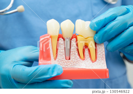 Dentist holding dental implant, artificial tooth roots into jaw, root canal of dental treatment, gum disease, teeth model for dentist. Dentist holding dental implant, artificial tooth roots into jaw, root canal of dental treatment, gum disease, teeth model for dentist. 130546922
