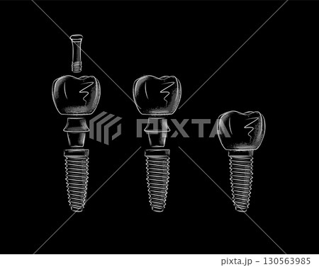 Tooth implant parts illustration black 130563985