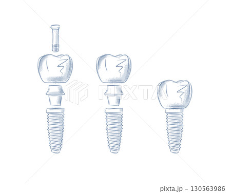 Tooth implant parts illustration blue 130563986