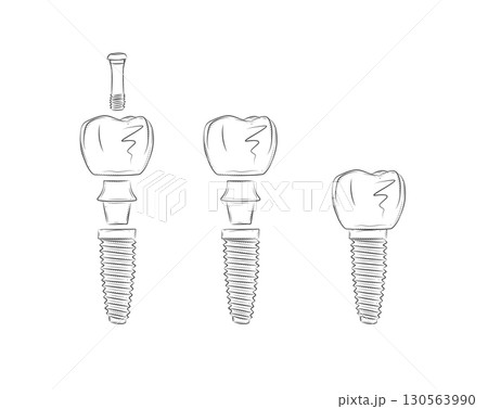 Tooth implant parts illustration Tooth implant parts illustration 130563990