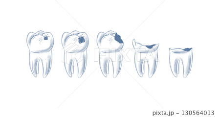 Life cycle of dental caries blue Life cycle of dental caries blue 130564013