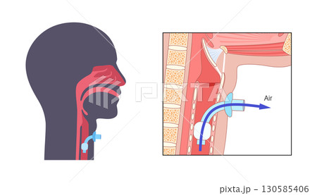 Tracheostomy medical poster 130585406