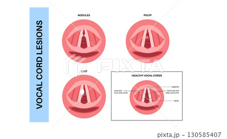 Vocal cord lesions Vocal cord lesions 130585407