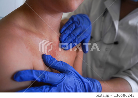 The boy's body displays signs of monkeypox infection. The boy's body displays signs of monkeypox infection. 130596243