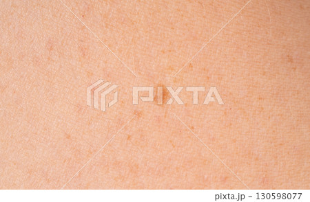 Skin mole spot closeup. Human birthmark, nevus macro texture Skin mole spot closeup. Human birthmark, nevus macro texture 130598077