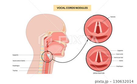 Vocal cord nodules Vocal cord nodules 130632014