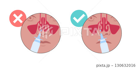 Proper nasal spray usage 130632016