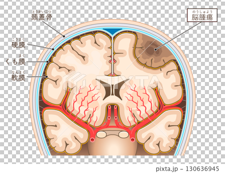 腦腫瘤插圖 腦腫瘤插圖 130636945