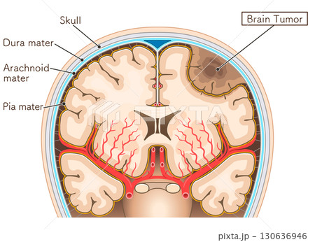 脳腫瘍のイラスト Brain tumor illustration 130636946