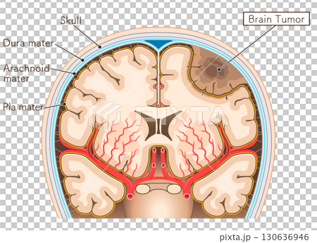 腦腫瘤插圖 130636946
