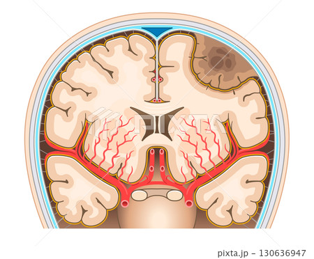 脳腫瘍のイラスト Brain tumor illustration 130636947