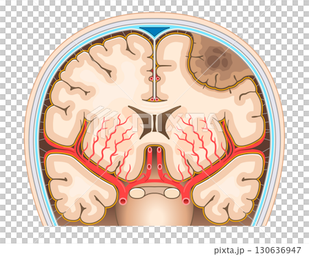 脳腫瘍のイラスト Brain tumor illustration 130636947