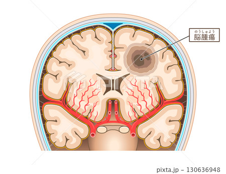 脳腫瘍のイラスト Brain tumor illustration 130636948