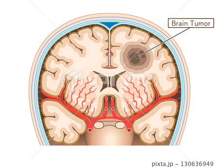 脳腫瘍のイラスト Brain tumor illustration 130636949