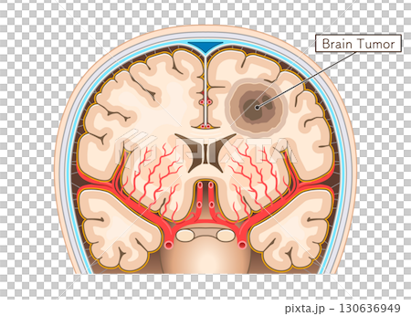脳腫瘍のイラスト Brain tumor illustration 130636949