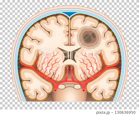 脳腫瘍のイラスト Brain tumor illustration 130636950