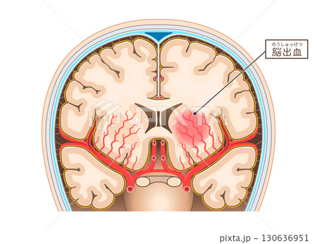脳出血のイラスト Illustration of cerebral hemorrhage 130636951