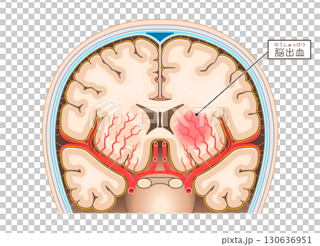 脳出血のイラスト Illustration of cerebral hemorrhage 130636951