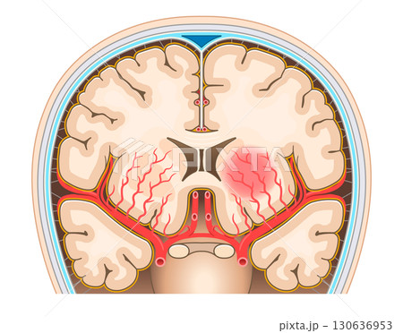 脳出血のイラスト Illustration of cerebral hemorrhage 130636953