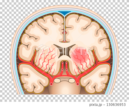脳出血のイラスト Illustration of cerebral hemorrhage 130636953