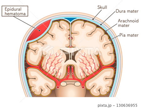 硬膜外血腫のイラストIllustration of an epidural hematoma 130636955