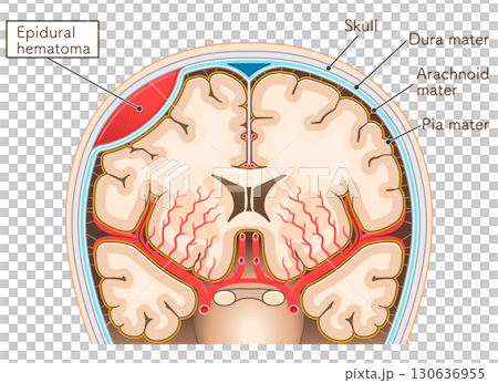 硬膜外血腫のイラストIllustration of an epidural hematoma 130636955