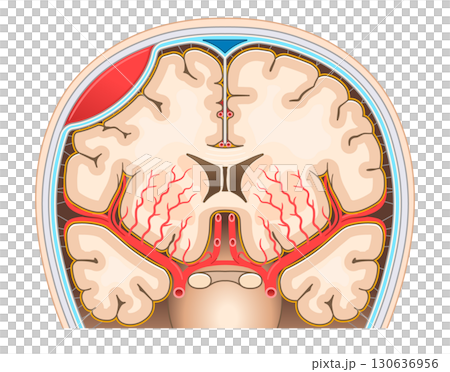 Illustration of an epidural hematoma 130636956