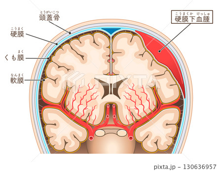 硬膜下血腫のイラスト Illustration of subdural hematoma 硬膜下血腫のイラスト Illustration of subdural hematoma 130636957