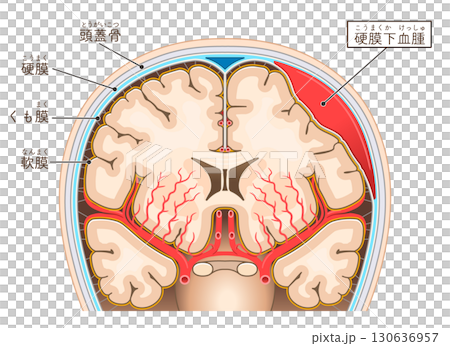 硬膜下血腫のイラスト Illustration of subdural hematoma 硬膜下血腫のイラスト Illustration of subdural hematoma 130636957