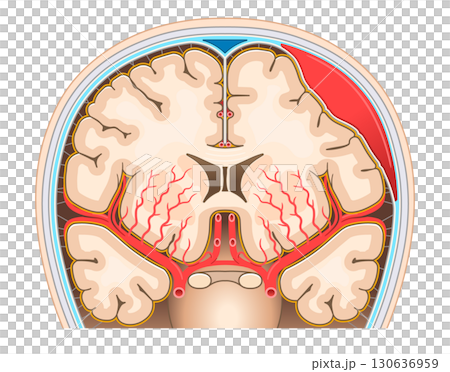 硬腦膜下血腫的圖示 硬腦膜下血腫的圖示 130636959
