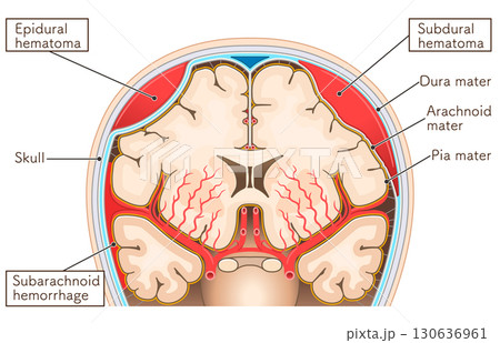 くも膜下出血・硬膜外血腫・硬膜下血腫のイラスト くも膜下出血・硬膜外血腫・硬膜下血腫のイラスト 130636961