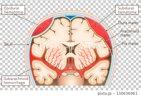くも膜下出血・硬膜外血腫・硬膜下血腫のイラスト くも膜下出血・硬膜外血腫・硬膜下血腫のイラスト 130636961