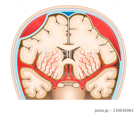 くも膜下出血・硬膜外血腫・硬膜下血腫のイラスト くも膜下出血・硬膜外血腫・硬膜下血腫のイラスト 130636962