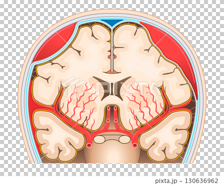 蛛網膜下腔出血、硬腦膜外血腫及硬腦膜下血腫的圖示 蛛網膜下腔出血、硬腦膜外血腫及硬腦膜下血腫的圖示 130636962