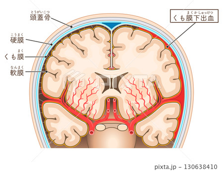 くも膜下出血のイラスト Illustration of subarachnoid hemorrhag 130638410
