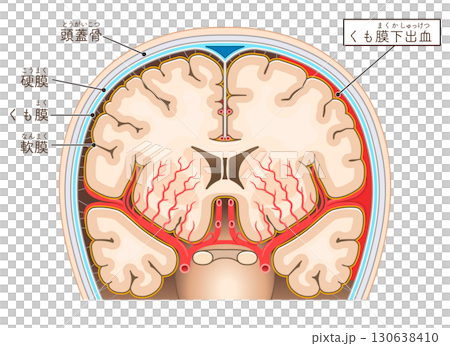 くも膜下出血のイラスト Illustration of subarachnoid hemorrhag 130638410