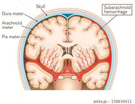 くも膜下出血のイラスト Illustration of subarachnoid hemorrhag くも膜下出血のイラスト Illustration of subarachnoid hemorrhag 130638411