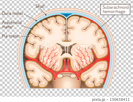 くも膜下出血のイラスト Illustration of subarachnoid hemorrhag くも膜下出血のイラスト Illustration of subarachnoid hemorrhag 130638411