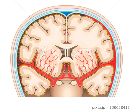 くも膜下出血のイラスト Illustration of subarachnoid hemorrhag くも膜下出血のイラスト Illustration of subarachnoid hemorrhag 130638412