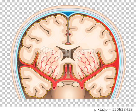 くも膜下出血のイラスト Illustration of subarachnoid hemorrhag くも膜下出血のイラスト Illustration of subarachnoid hemorrhag 130638412