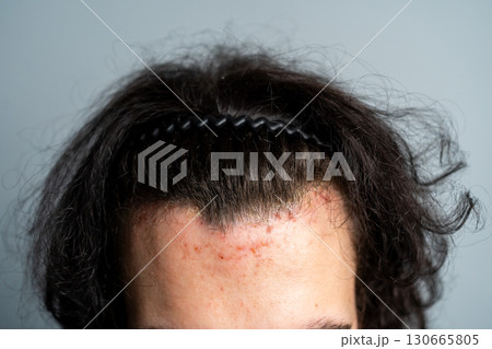 Close-up of a young man s forehead with acne and irritated skin near the hairline, isolated background. Close-up of a young man s forehead with acne and irritated skin near the hairline, isolated background. 130665805