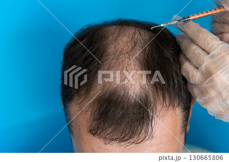 The Hair Restoration Procedure involves advanced Injection Treatments for rejuvenating hair The Hair Restoration Procedure involves advanced Injection Treatments for rejuvenating hair 130665806