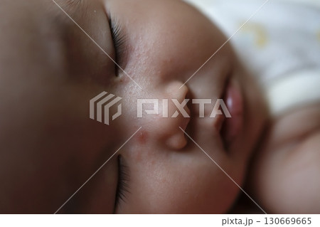 赤ちゃんの顔にできた蚊の刺され跡と眠る姿のクローズアップ 赤ちゃんの顔にできた蚊の刺され跡と眠る姿のクローズアップ 130669665