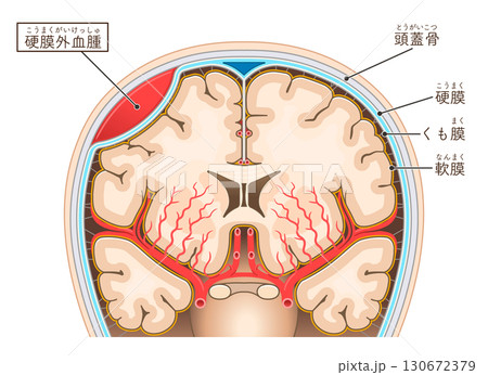 硬膜外血腫のイラストIllustration of an epidural hematoma 硬膜外血腫のイラストIllustration of an epidural hematoma 130672379