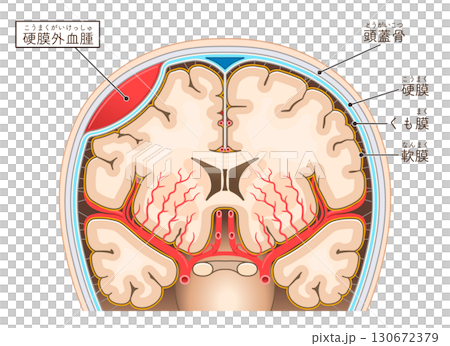 硬腦膜外血腫的圖示 硬腦膜外血腫的圖示 130672379