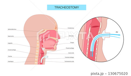 Tracheostomy medical poster 130675020